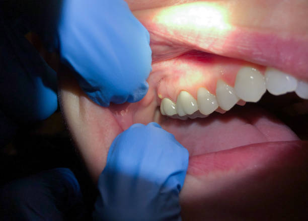 Best Emergency Dental Extractions in Munford, AL
