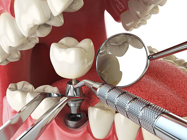Best Emergency Root Canal Treatment in Munford, AL
